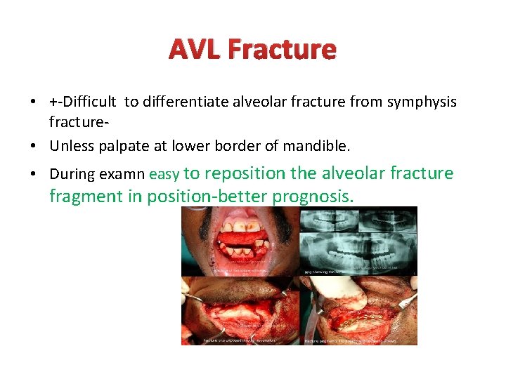 AVL Fracture • +-Difficult to differentiate alveolar fracture from symphysis fracture • Unless palpate AVL Fracture • +-Difficult to differentiate alveolar fracture from symphysis fracture • Unless palpate