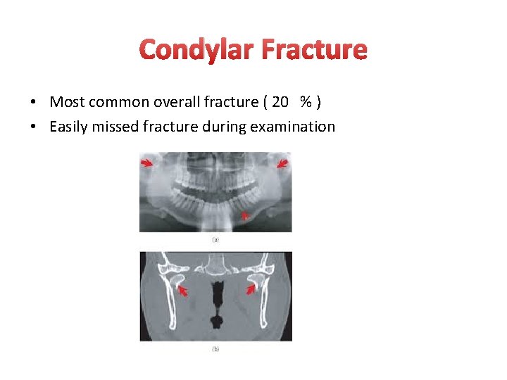 Condylar Fracture • Most common overall fracture ( 20 % ) • Easily missed