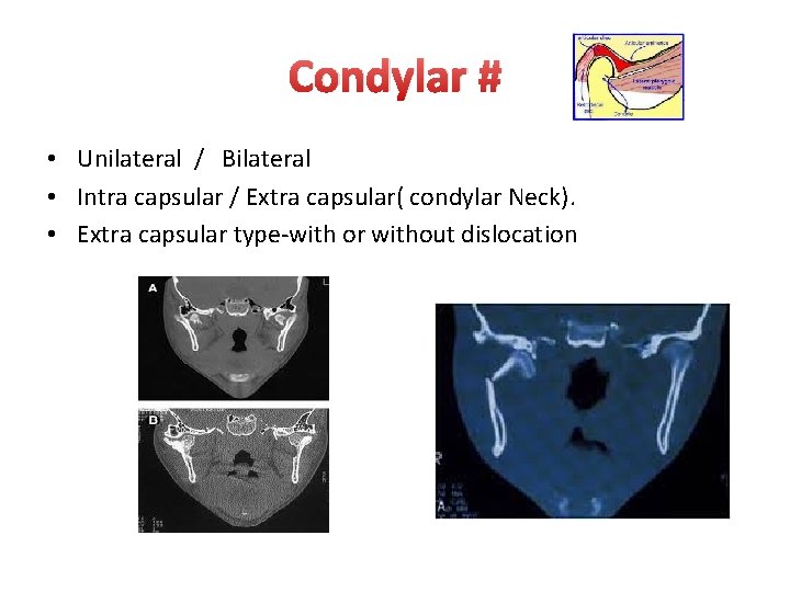 Condylar # • Unilateral / Bilateral • Intra capsular / Extra capsular( condylar Neck).