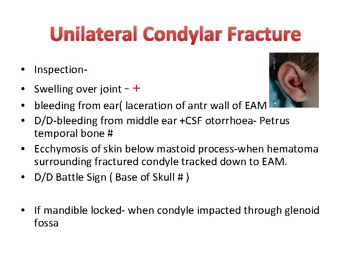 Unilateral Condylar Fracture • Inspection • Swelling over joint - + • bleeding from