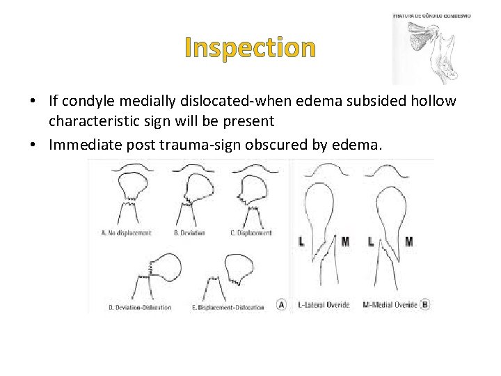 Inspection • If condyle medially dislocated-when edema subsided hollow characteristic sign will be present