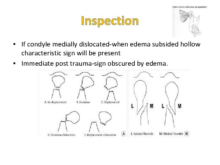 Inspection • If condyle medially dislocated-when edema subsided hollow characteristic sign will be present Inspection • If condyle medially dislocated-when edema subsided hollow characteristic sign will be present