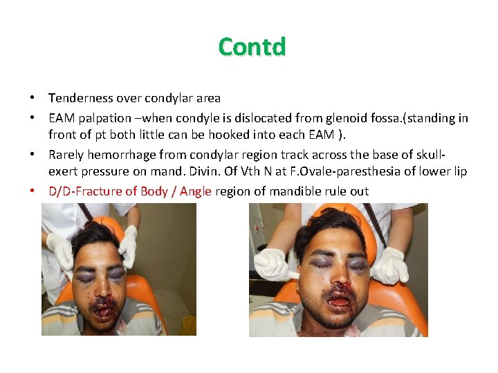 Contd • Tenderness over condylar area • EAM palpation –when condyle is dislocated from