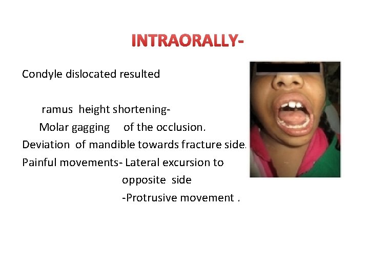 INTRAORALLYCondyle dislocated resulted ramus height shortening. Molar gagging of the occlusion. Deviation of mandible