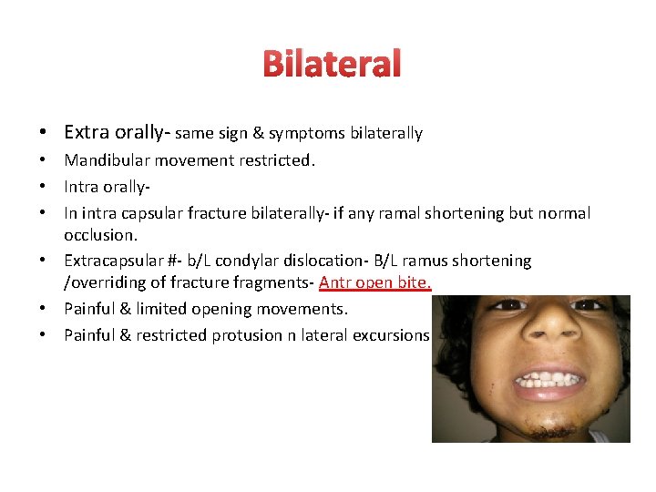 Bilateral • Extra orally- same sign & symptoms bilaterally • Mandibular movement restricted. •