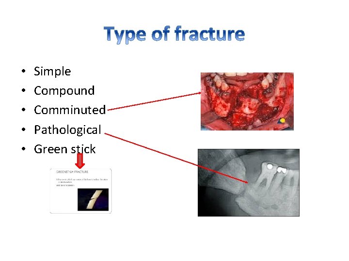  • • • Simple Compound Comminuted Pathological Green stick 