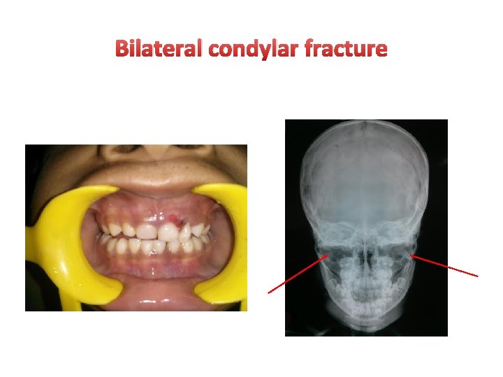 Bilateral condylar fracture 