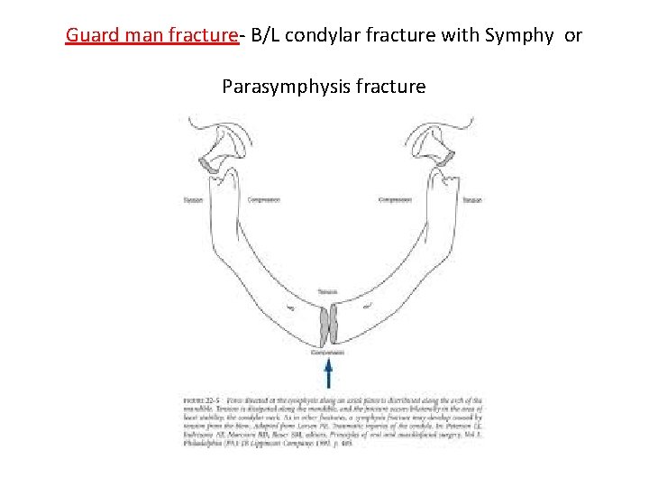 Guard man fracture- B/L condylar fracture with Symphy or Parasymphysis fracture 