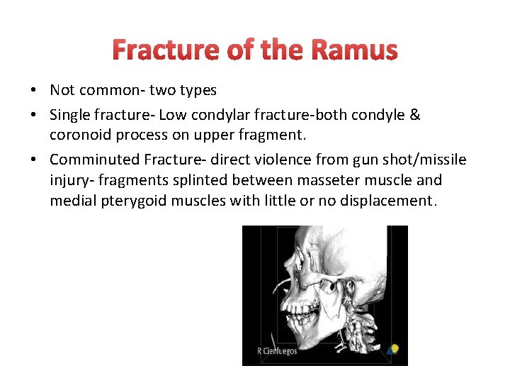 Fracture of the Ramus • Not common- two types • Single fracture- Low condylar Fracture of the Ramus • Not common- two types • Single fracture- Low condylar