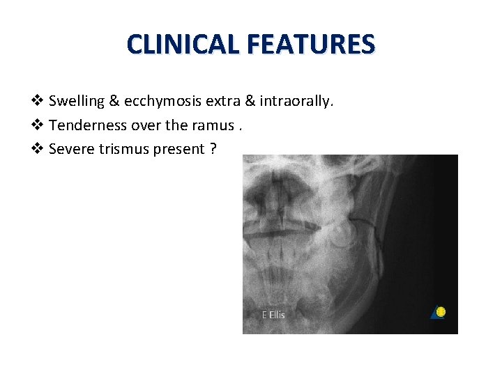 CLINICAL FEATURES v Swelling & ecchymosis extra & intraorally. v Tenderness over the ramus. CLINICAL FEATURES v Swelling & ecchymosis extra & intraorally. v Tenderness over the ramus.
