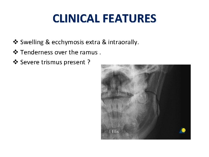 CLINICAL FEATURES v Swelling & ecchymosis extra & intraorally. v Tenderness over the ramus.