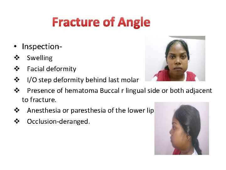 Fracture of Angle • Inspection. Swelling Facial deformity I/O step deformity behind last molar