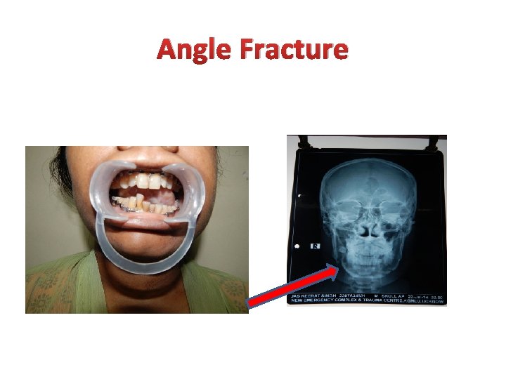 Angle Fracture 