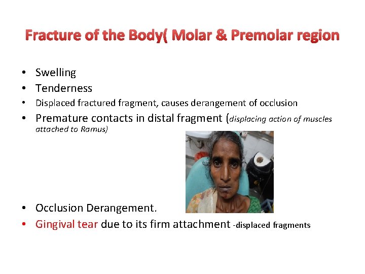 Fracture of the Body( Molar & Premolar region • Swelling • Tenderness • Displaced