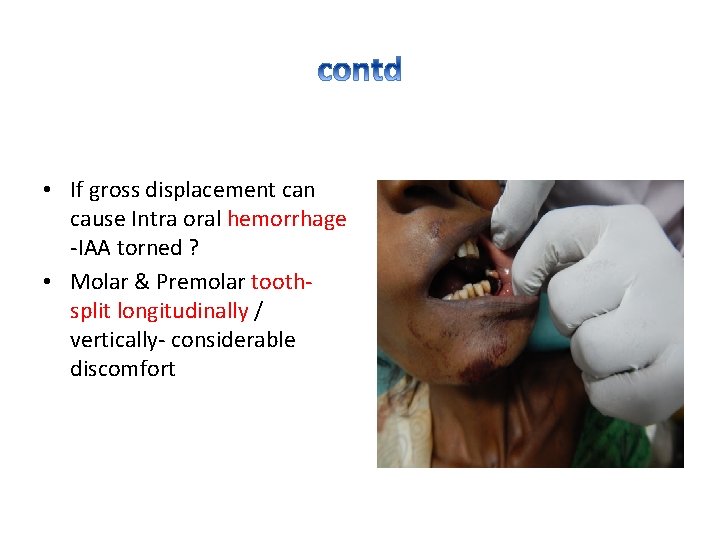  • If gross displacement can cause Intra oral hemorrhage -IAA torned ? •