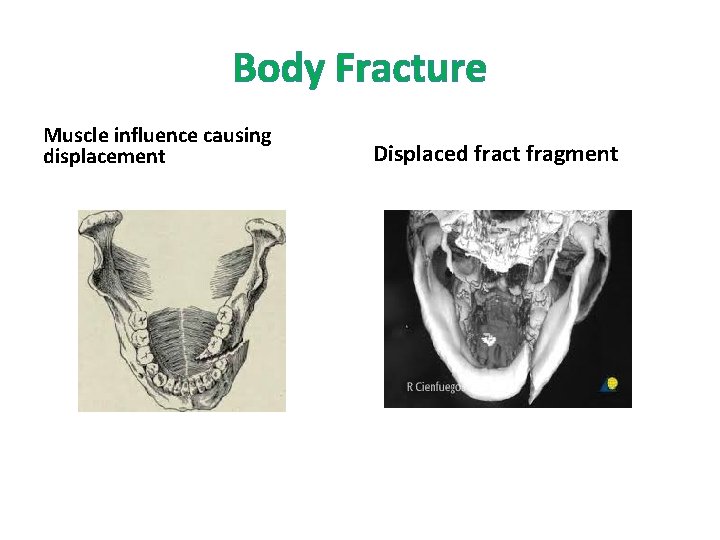Body Fracture Muscle influence causing displacement Displaced fract fragment 