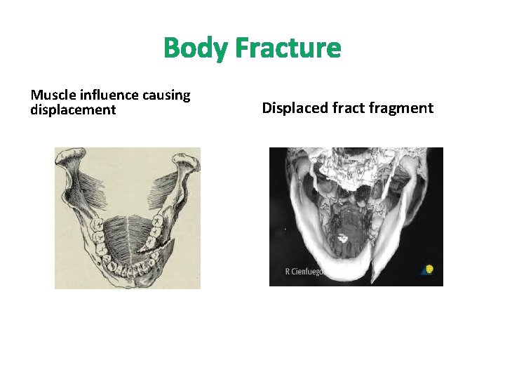 Body Fracture Muscle influence causing displacement Displaced fract fragment Body Fracture Muscle influence causing displacement Displaced fract fragment