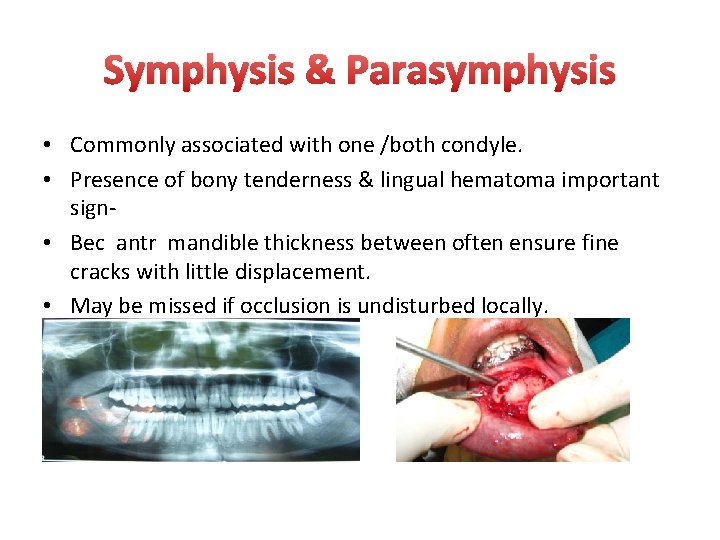 Symphysis & Parasymphysis • Commonly associated with one /both condyle. • Presence of bony