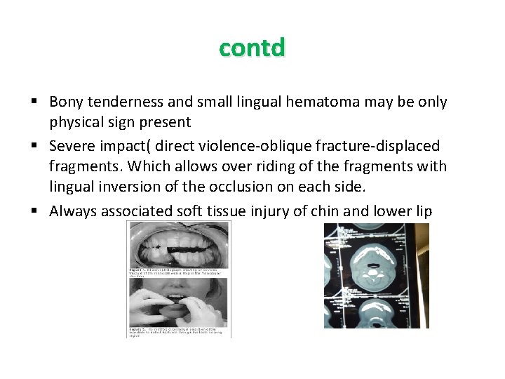 contd § Bony tenderness and small lingual hematoma may be only physical sign present