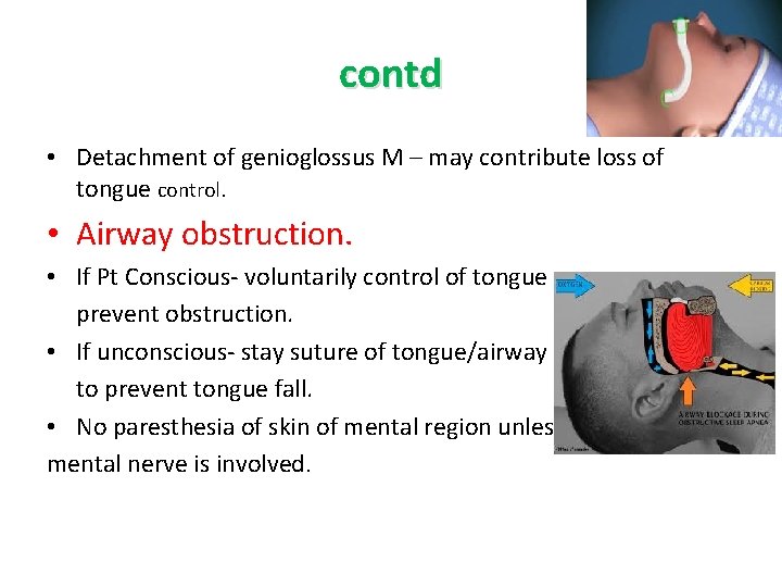 contd • Detachment of genioglossus M – may contribute loss of tongue control. •
