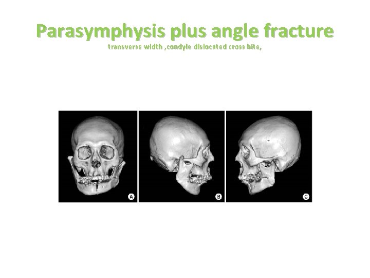 Parasymphysis plus angle fracture transverse width , condyle dislocated cross bite, 