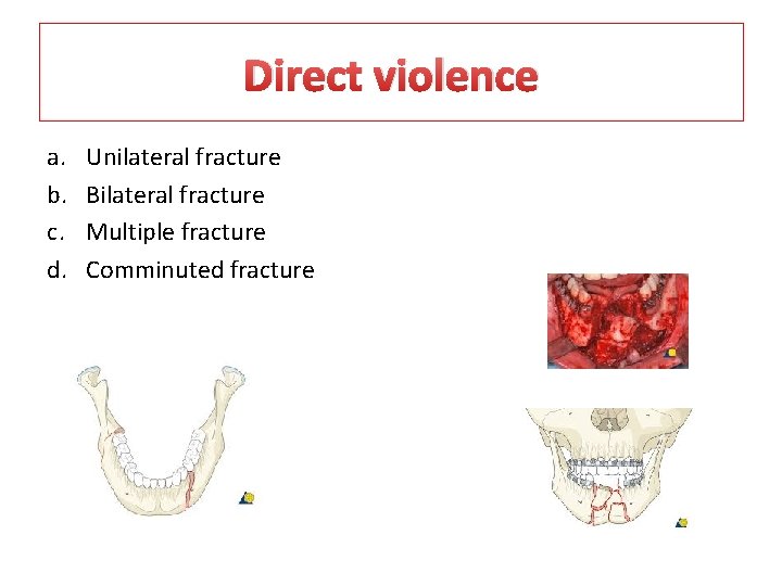 Direct violence a. b. c. d. Unilateral fracture Bilateral fracture Multiple fracture Comminuted fracture