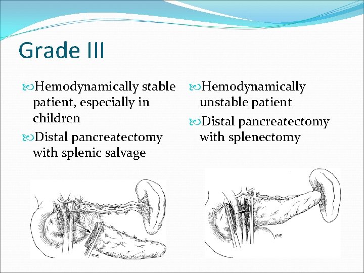 Grade III Hemodynamically stable Hemodynamically patient, especially in unstable patient children Distal pancreatectomy with