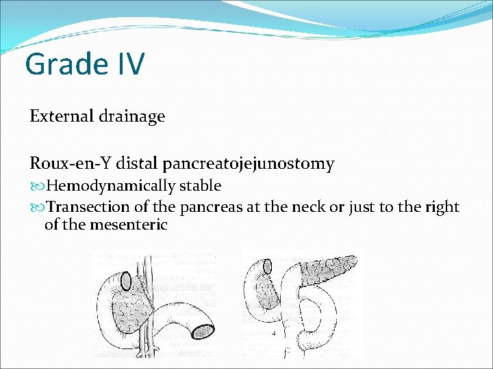 Grade IV External drainage Roux-en-Y distal pancreatojejunostomy Hemodynamically stable Transection of the pancreas at