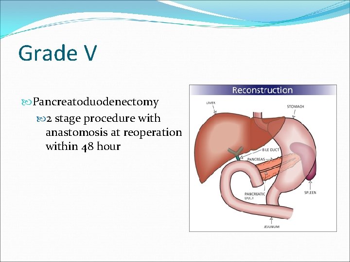 Grade V Pancreatoduodenectomy 2 stage procedure with anastomosis at reoperation within 48 hour 