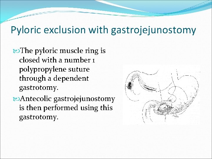 Pyloric exclusion with gastrojejunostomy The pyloric muscle ring is closed with a number 1