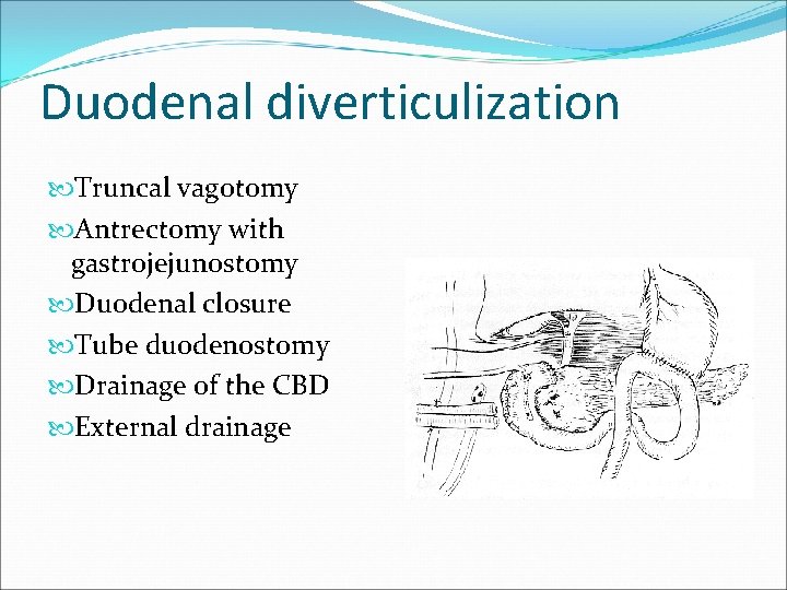 Duodenal diverticulization Truncal vagotomy Antrectomy with gastrojejunostomy Duodenal closure Tube duodenostomy Drainage of the