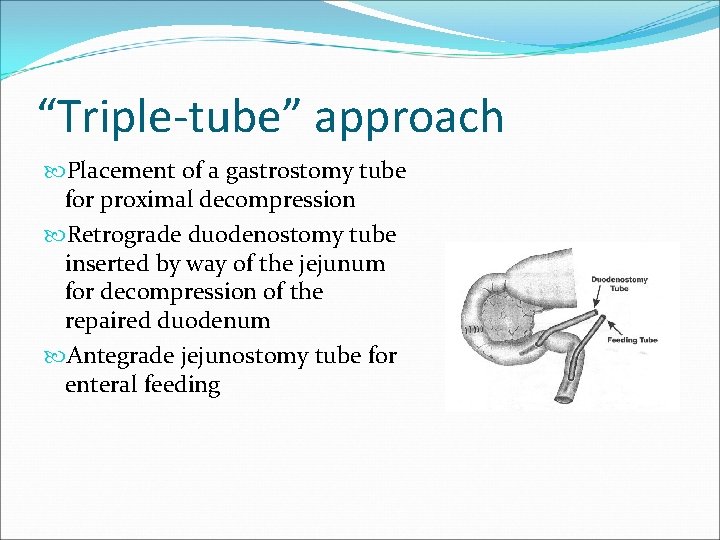 “Triple-tube” approach Placement of a gastrostomy tube for proximal decompression Retrograde duodenostomy tube inserted