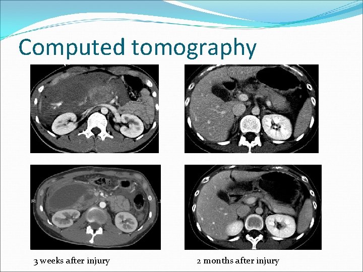 Computed tomography 3 weeks after injury 2 months after injury 