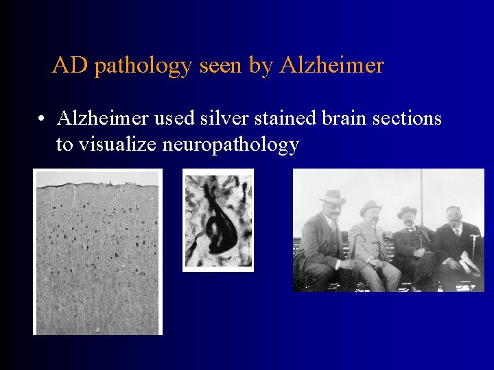 AD pathology seen by Alzheimer • Alzheimer used silver stained brain sections to visualize