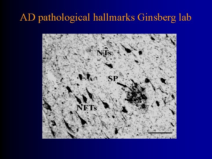 AD pathological hallmarks Ginsberg lab 