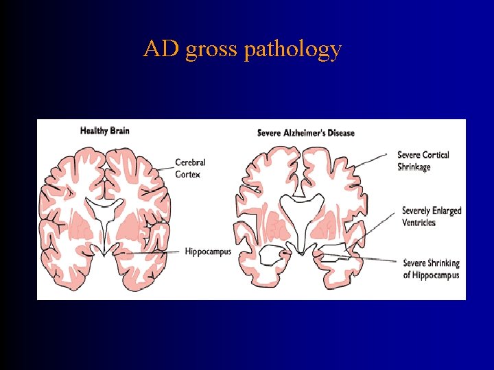 AD gross pathology 