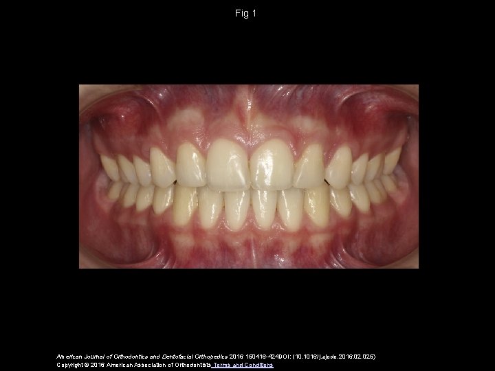 Fig 1 American Journal of Orthodontics and Dentofacial Orthopedics 2016 150416 -424 DOI: (10.