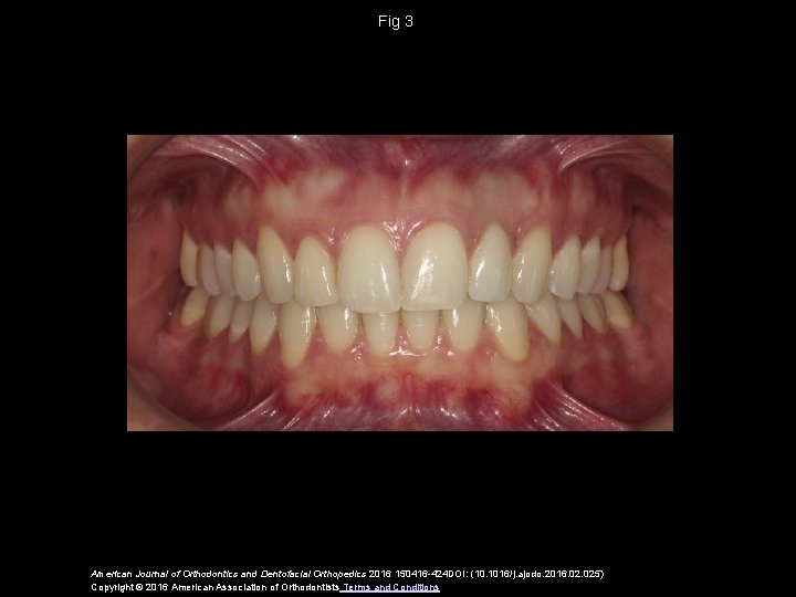 Fig 3 American Journal of Orthodontics and Dentofacial Orthopedics 2016 150416 -424 DOI: (10.