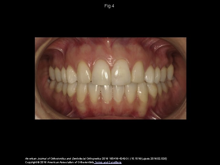 Fig 4 American Journal of Orthodontics and Dentofacial Orthopedics 2016 150416 -424 DOI: (10.