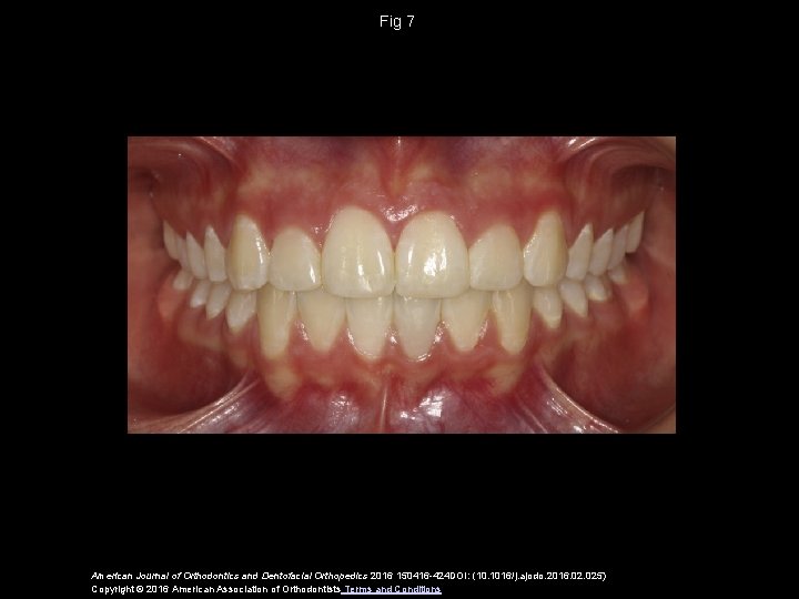 Fig 7 American Journal of Orthodontics and Dentofacial Orthopedics 2016 150416 -424 DOI: (10.