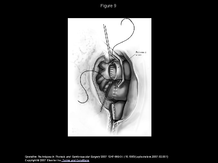 Figure 9 Operative Techniques in Thoracic and Cardiovascular Surgery 2007 1247 -56 DOI: (10.