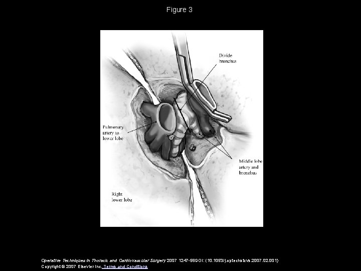 Figure 3 Operative Techniques in Thoracic and Cardiovascular Surgery 2007 1247 -56 DOI: (10.