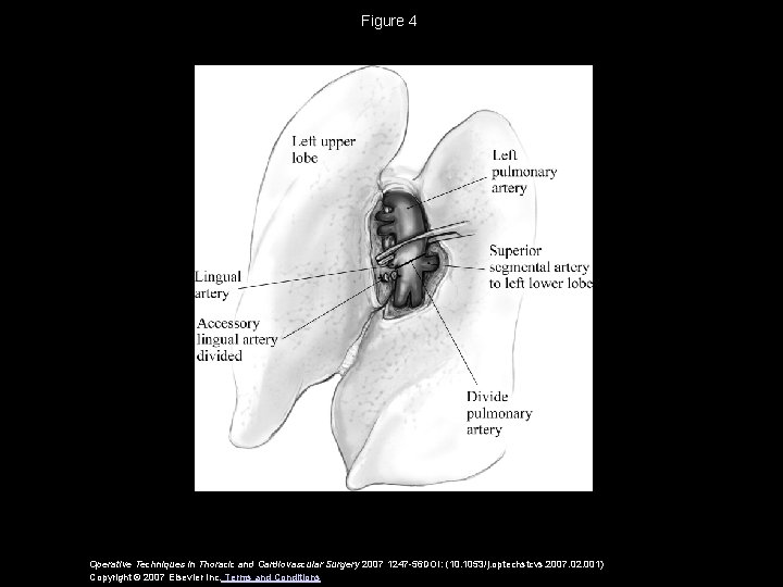 Figure 4 Operative Techniques in Thoracic and Cardiovascular Surgery 2007 1247 -56 DOI: (10.