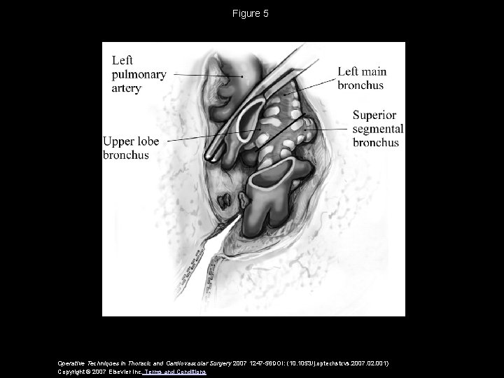 Figure 5 Operative Techniques in Thoracic and Cardiovascular Surgery 2007 1247 -56 DOI: (10.