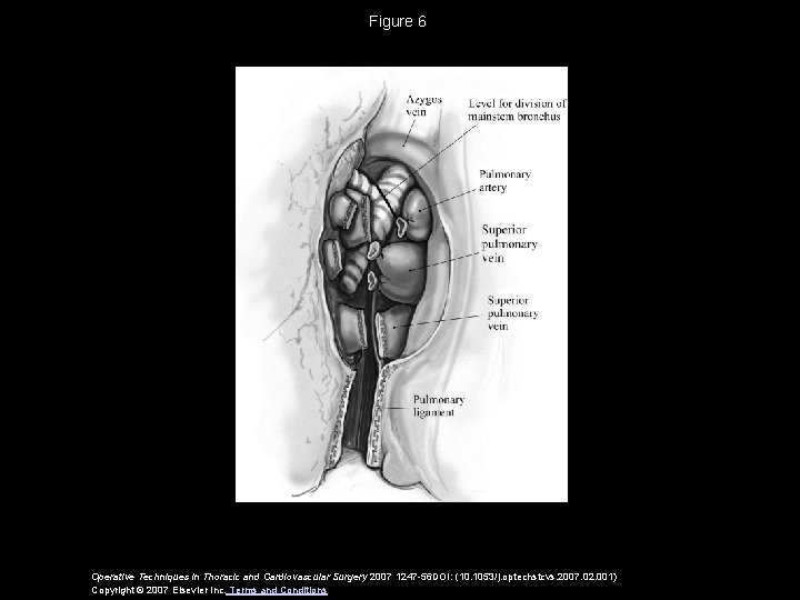 Figure 6 Operative Techniques in Thoracic and Cardiovascular Surgery 2007 1247 -56 DOI: (10.
