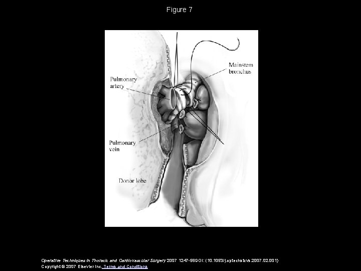 Figure 7 Operative Techniques in Thoracic and Cardiovascular Surgery 2007 1247 -56 DOI: (10.