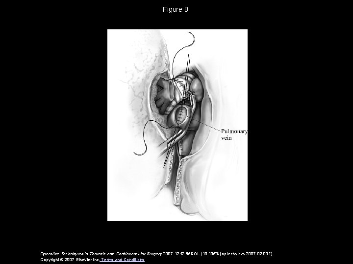 Figure 8 Operative Techniques in Thoracic and Cardiovascular Surgery 2007 1247 -56 DOI: (10.