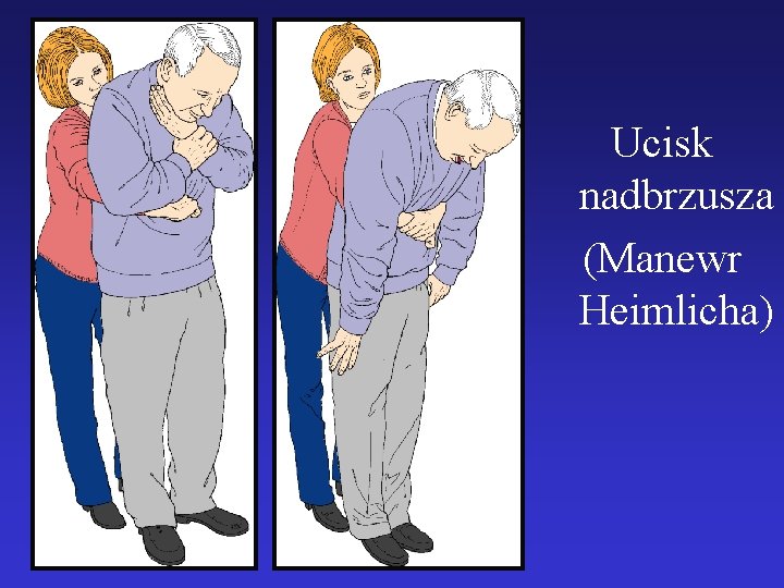 Ucisk nadbrzusza (Manewr Heimlicha) 