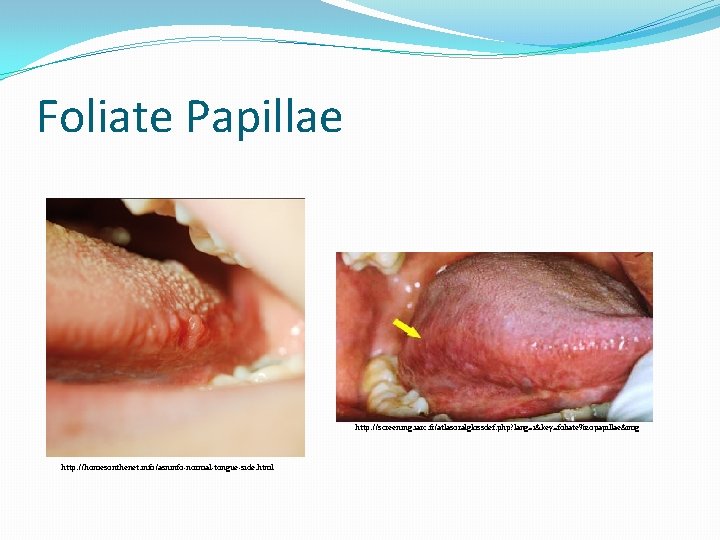 Foliate Papillae http: //screening. iarc. fr/atlasoralglossdef. php? lang=1&key=foliate%20 papillae&img http: //homesonthenet. info/asninfo-normal-tongue-side. html 