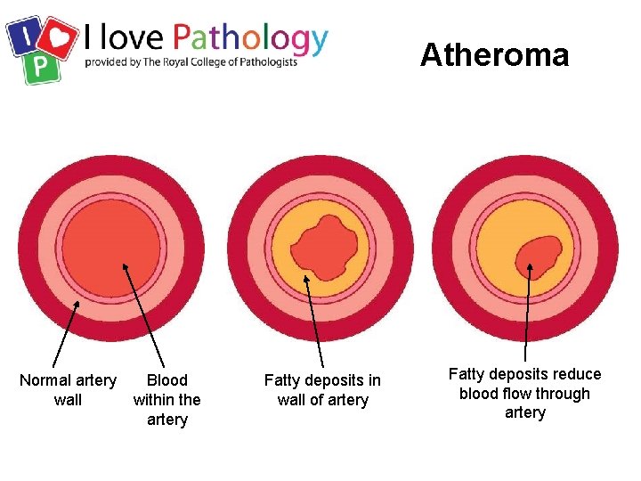 Atheroma Normal artery wall Blood within the artery Fatty deposits in wall of artery
